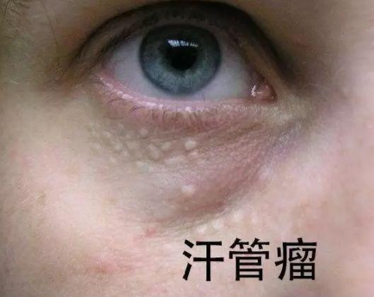 两个月婴儿脂肪粒图片，了解、识别与应对