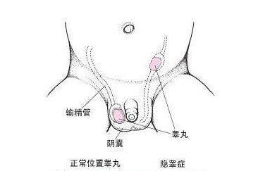 两个月男宝宝睾丸偏大，了解、关注与应对